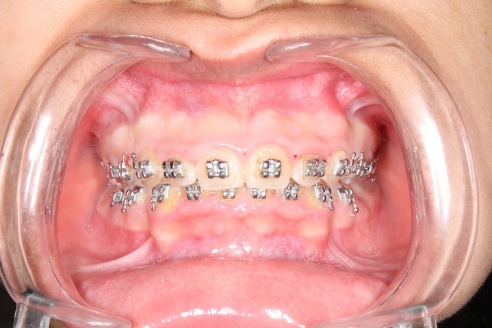 Ortodoncia Sincelejo